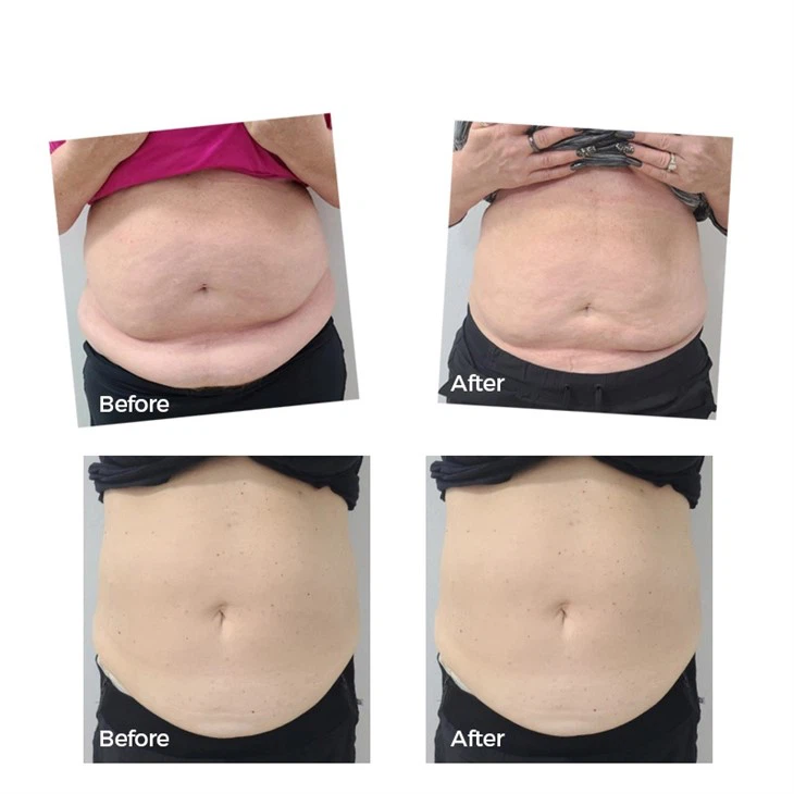 fat burning laser machine (3)